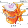 頚椎椎間板ヘルニア