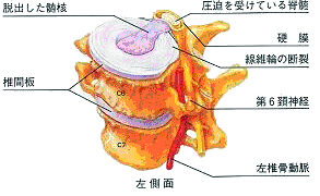 頚椎椎間板ヘルニア