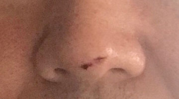鼻先の傷